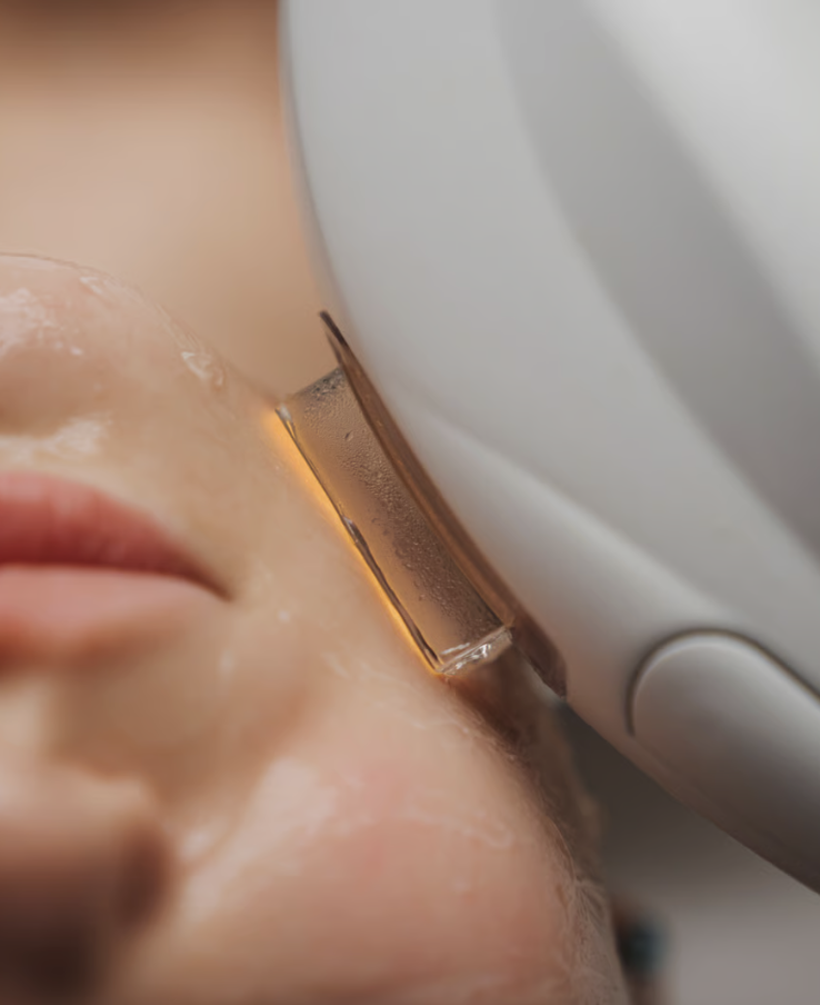 IPL facial en León | Tratamiento de manchas | Plenitude Clinic